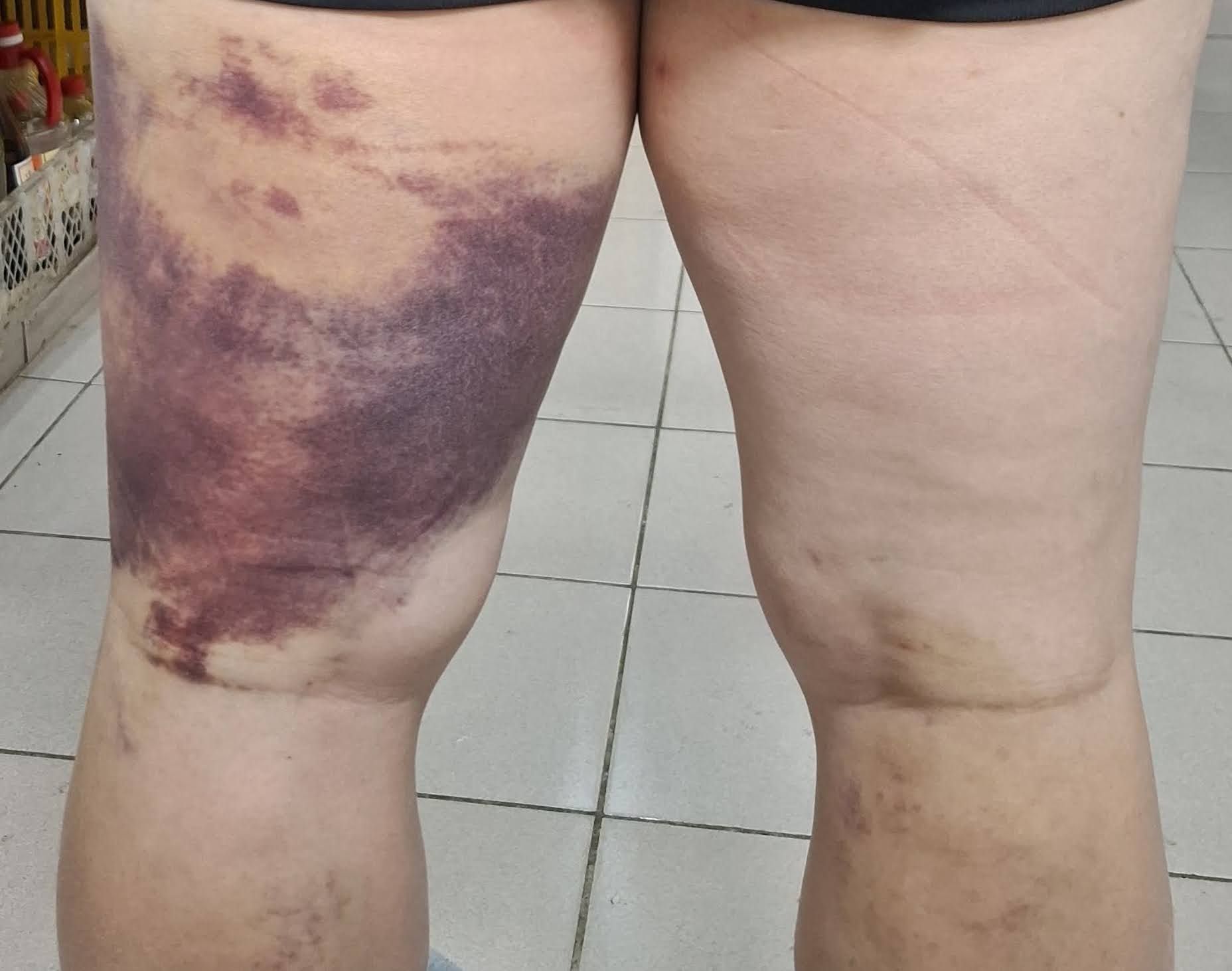 苗栗縣社運人士陳祺忠先前在住家附近遇襲，腿部嚴重瘀青。（翻攝陳祺忠臉書）