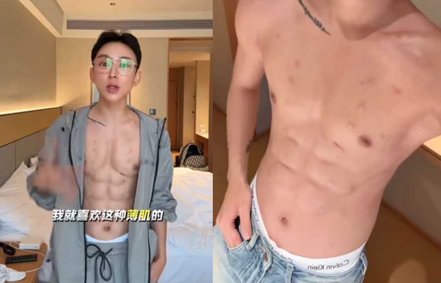 黑龍江一名網紅利用注射玻尿酸雕塑腹肌，在社群上公開術後成果。（翻攝bilibili）