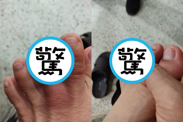 國中男學生腳趾突變黑，原來是這毒蟲躲進鞋裡！毒液可噴25公分嚇壞網友。（翻攝自臉書）