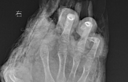 中國湖北武漢一名12歲男童因為調皮，意外把自己的3根手指炸斷。（翻攝自極目新聞）