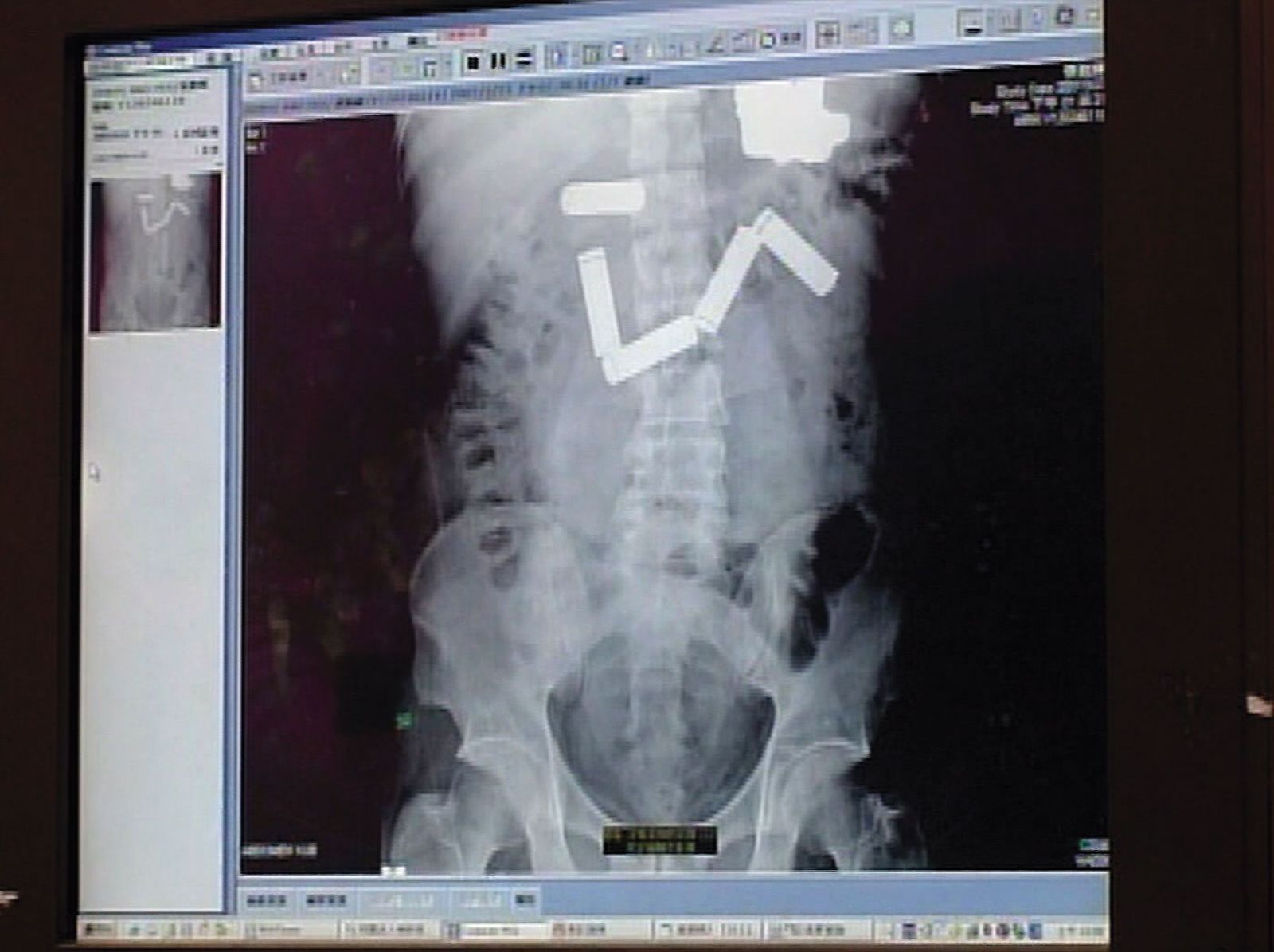 張胞輝等待槍決期間，在看守所吞電池自殺，送醫開刀後撿回一命。（東森新聞提供）