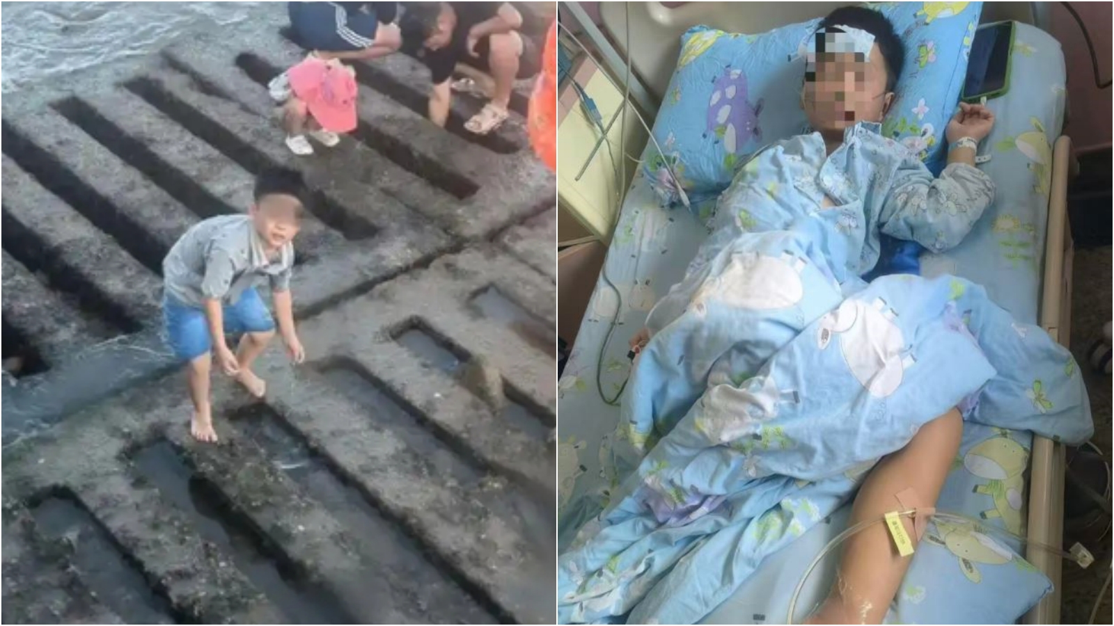 男童光腳踩到死魚染「海洋無聲殺手」，腿險些沒了。（翻攝抖音）