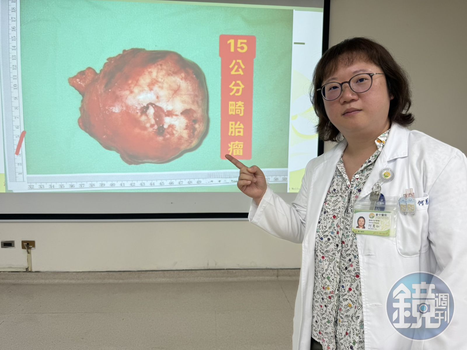 驚見15公分巨大腫瘤和心臟一樣大! 醫師:母體胚胎發育的畸胎瘤
