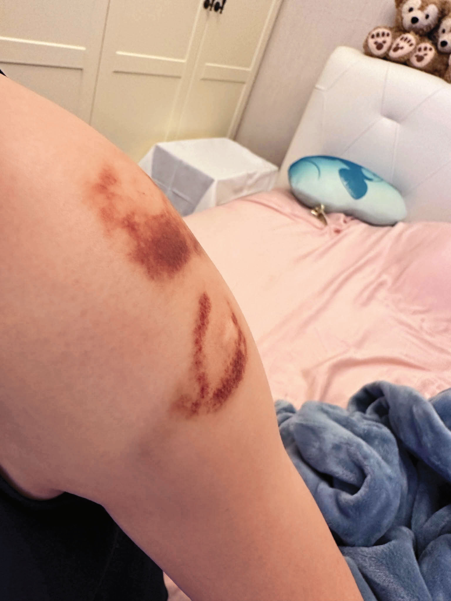 張妻（圖）與丈夫發生衝突，傷痕累累，最後聲請保護令獲准。（讀者提供）