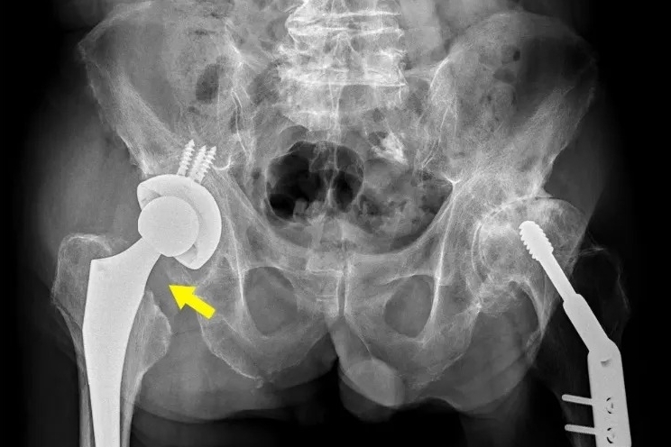 74歲施姓男子長年獨力照顧病母，導致腰與髖部長期疼痛，黃箭頭是右側置換人工髖關節位置。（澄清醫院中港院區提供）