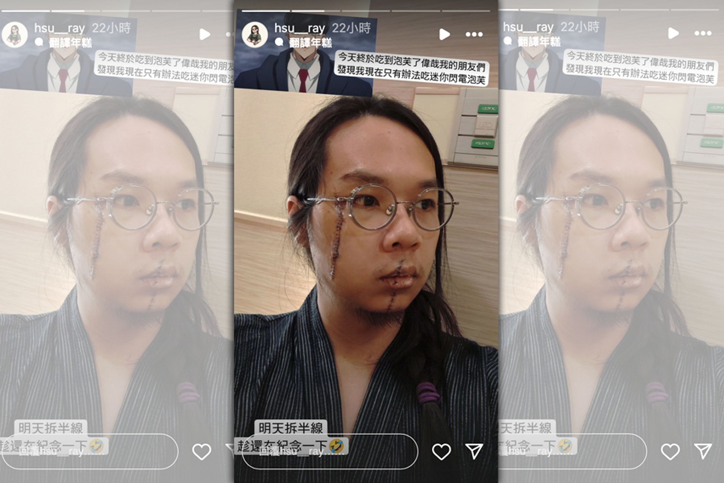 一名網友昨(27日)在PTT發文,只見長髮哥臉上有兩道明顯縫合傷疤。(翻攝自PTT)