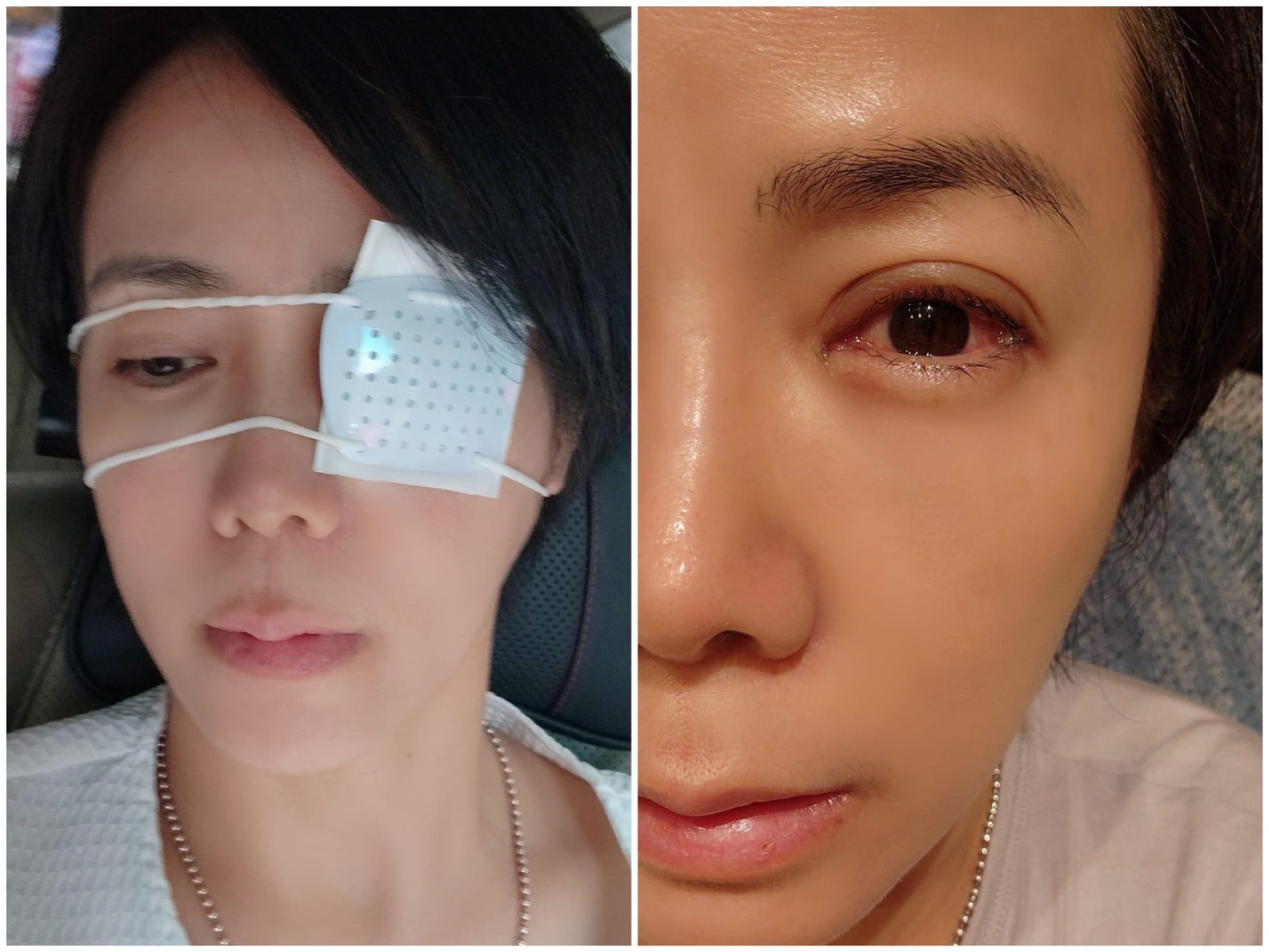 陳仙梅半夜陪睡遭兒子戳傷眼。（翻攝自臉書）