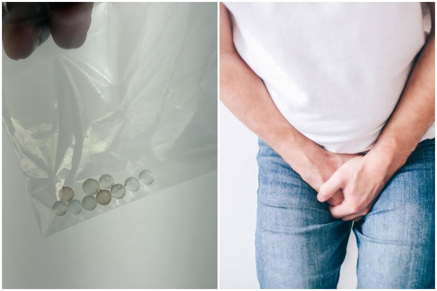 泌尿科診所院長高銘鴻臉書粉專分享入珠猛男個案。（翻攝自pixabay、臉書高銘鴻）