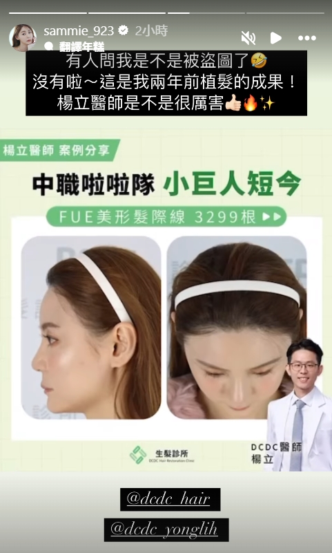 短今在IG限時動態PO出她植髮後的照片,澄清該廣告沒有盜圖。(翻攝自IG sammie_923)