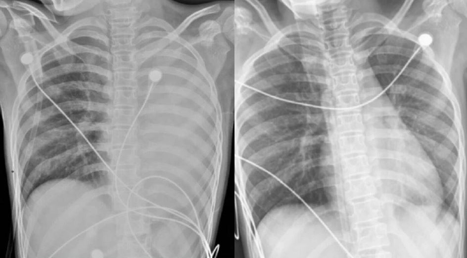 12歲女孩僅僅發燒1天，左肺就呈現「白肺」狀態。（翻攝自重慶日報）