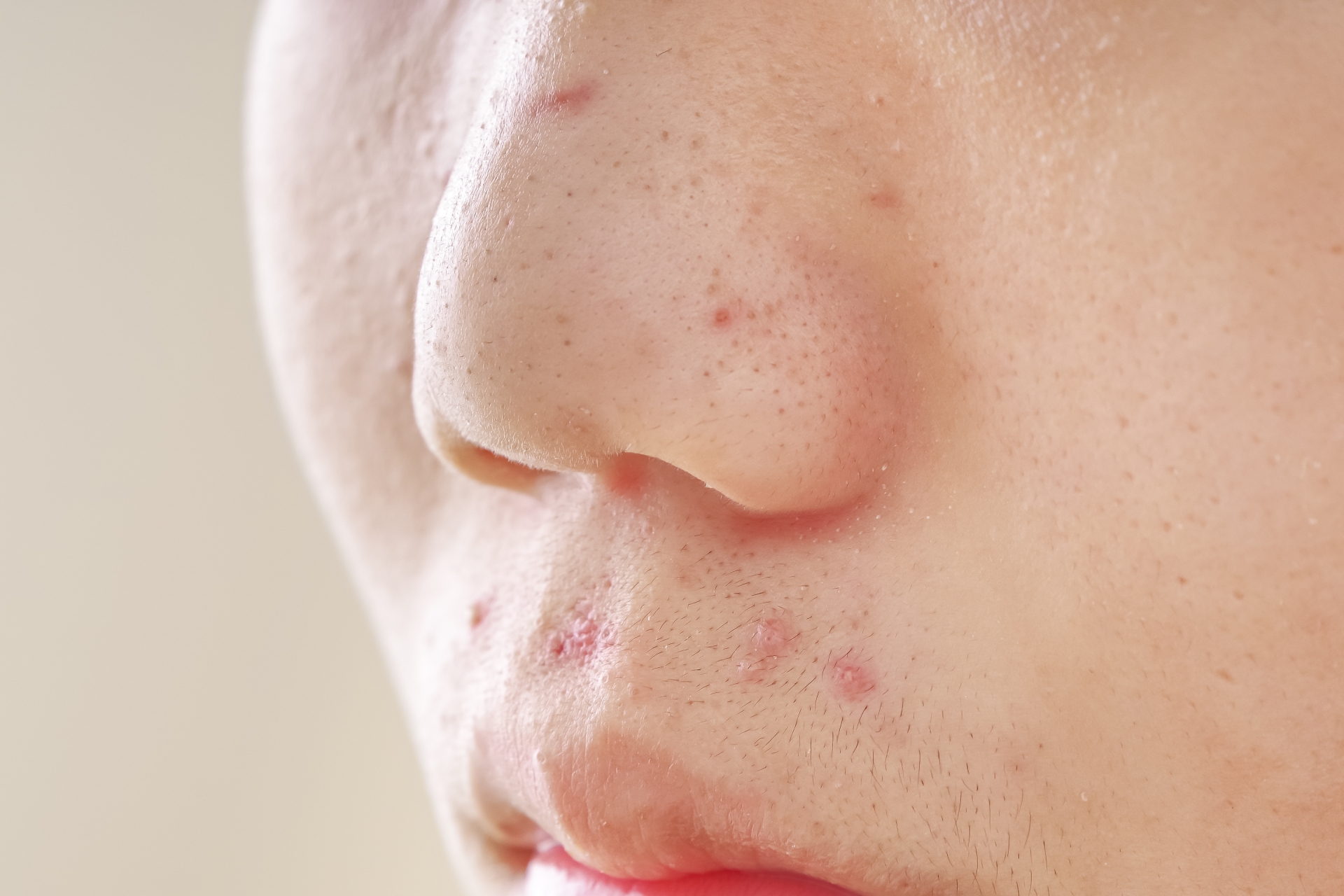 一名女子因擠壓長在「死亡三角區」的痘痘，導致出現半邊臉部癱瘓的情況。（翻攝自photo-ac）