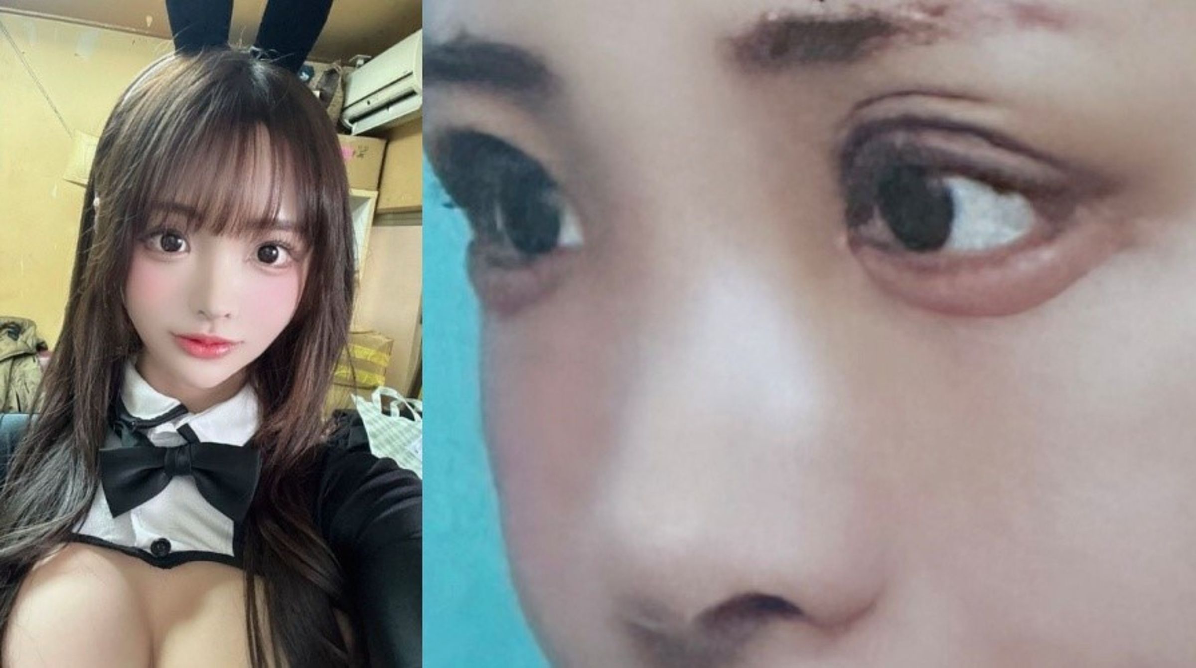 白濱希爆眼部整形手術失敗,5度修補仍無法挽回 ,尋求店家賠償卻未果,形象受損無法回歸拍片。(翻攝自X)