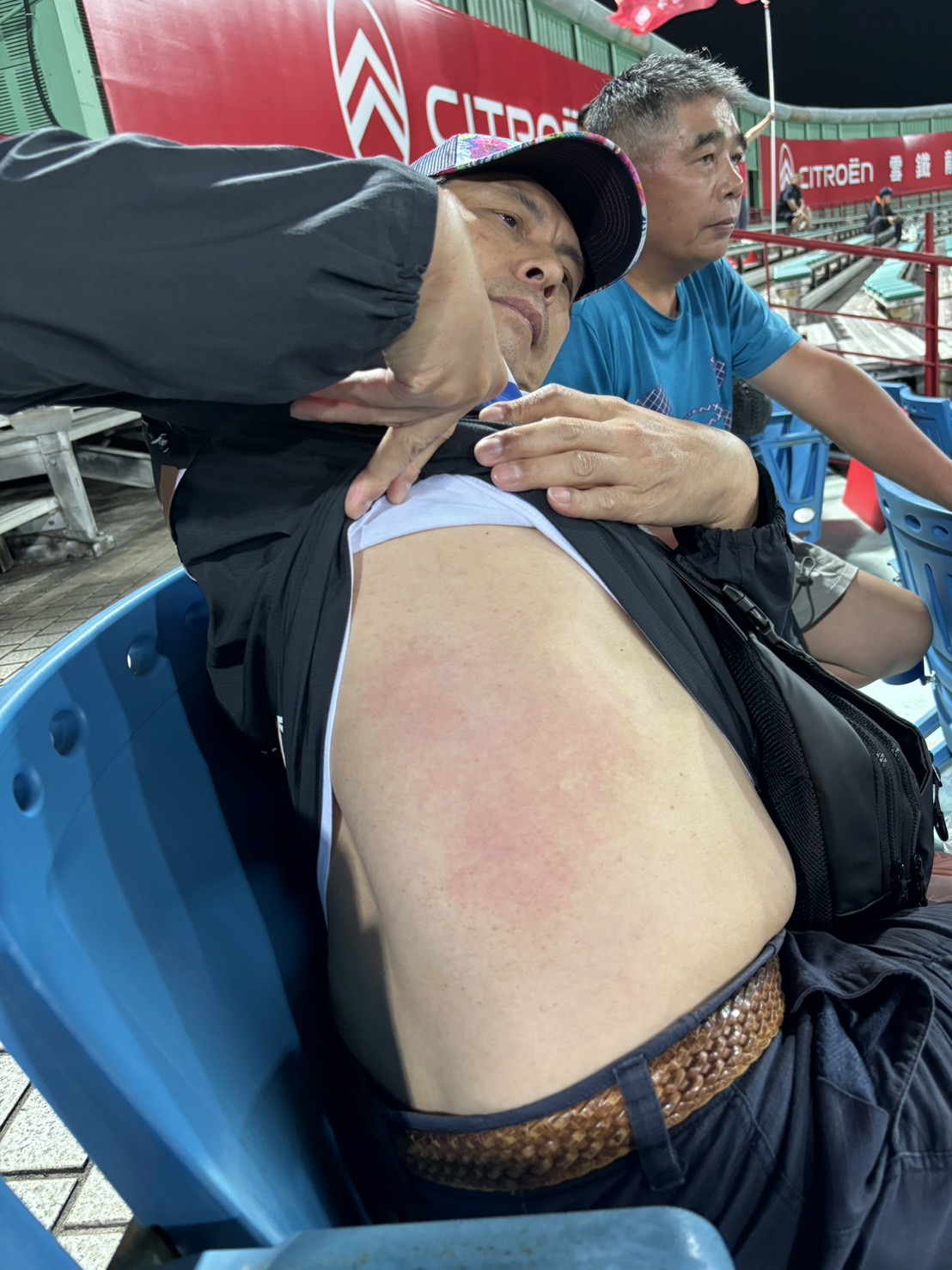 蘇炳憲分享身上被棒球砸傷的瘀青。(民視提供)