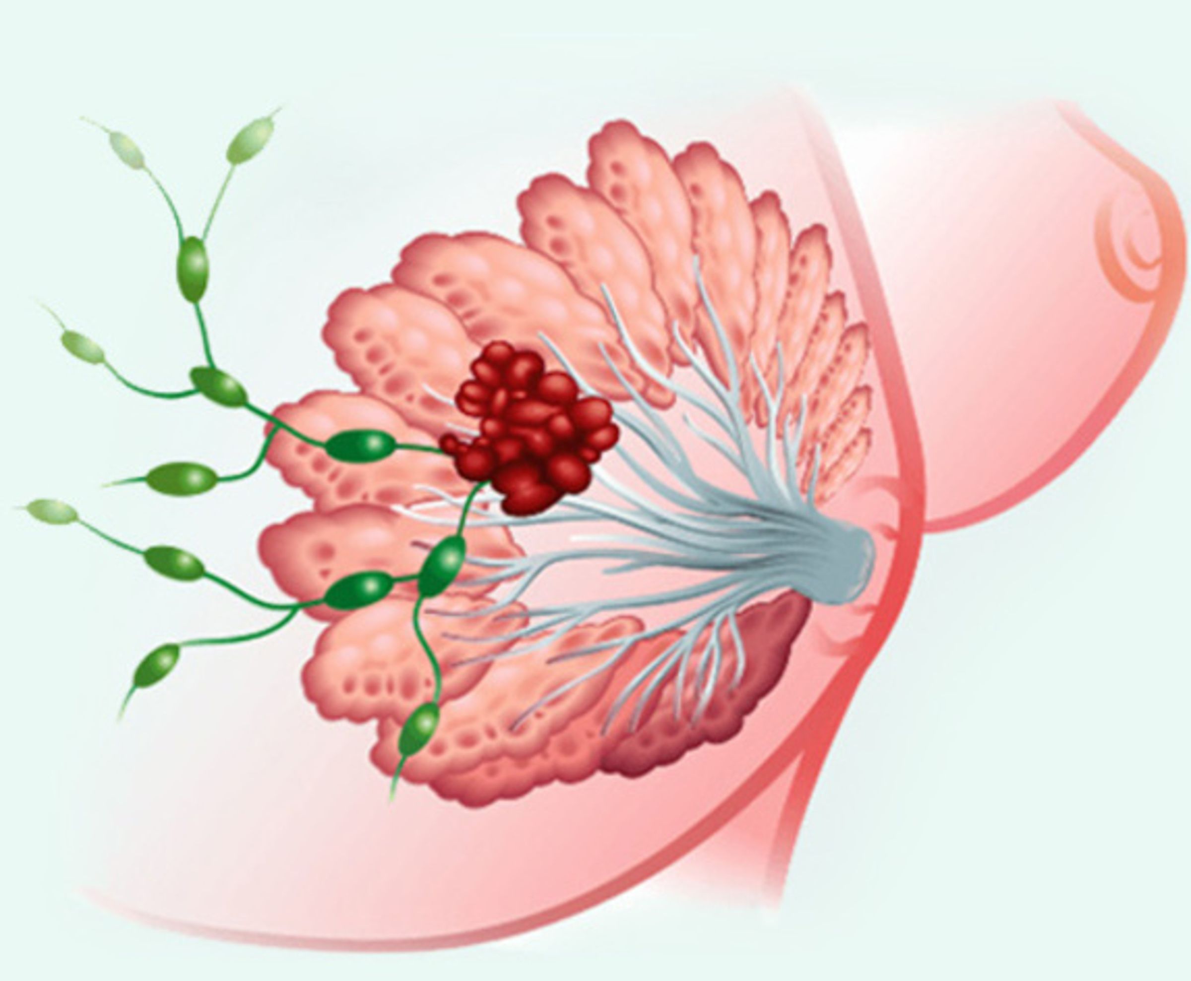 生華科研發中的Pidnarulex(CX-5461)抗癌藥物,能狙擊多達五種癌症腫瘤,尤其在加拿大一期、二期乳癌人體臨床試驗中,已證明能有效讓腫瘤縮小。(生華科提供)