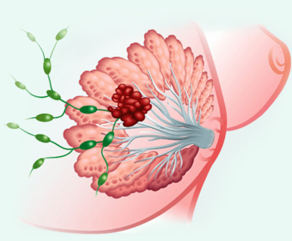生華科研發中的Pidnarulex（CX-5461）抗癌藥物，能狙擊多達五種癌症腫瘤，尤其在加拿大一期、二期乳癌人體臨床試驗中，已證明能有效讓腫瘤縮小。（生華科提供）