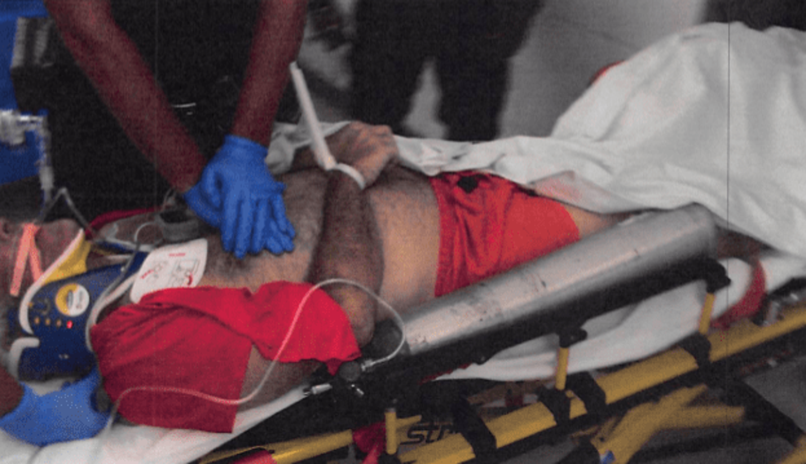 淫魔艾普斯坦急救「腫脹照」曝光 頸部深紅勒痕、喉骨幾乎全斷