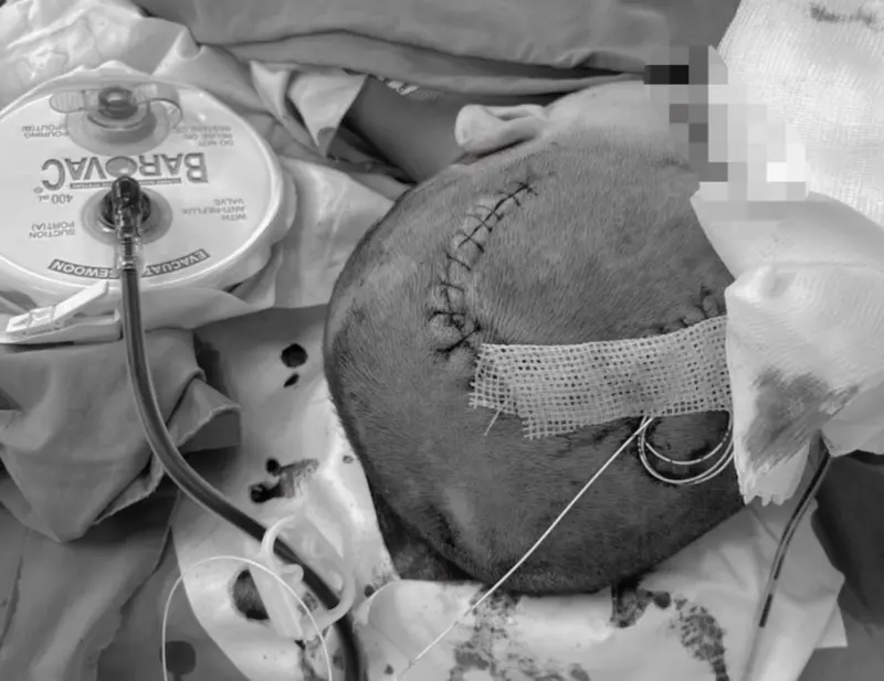 男童不慎從上舖樓梯跌落,送醫後經電腦斷層檢查發現顱內嚴重出血。(耕莘醫院提供)