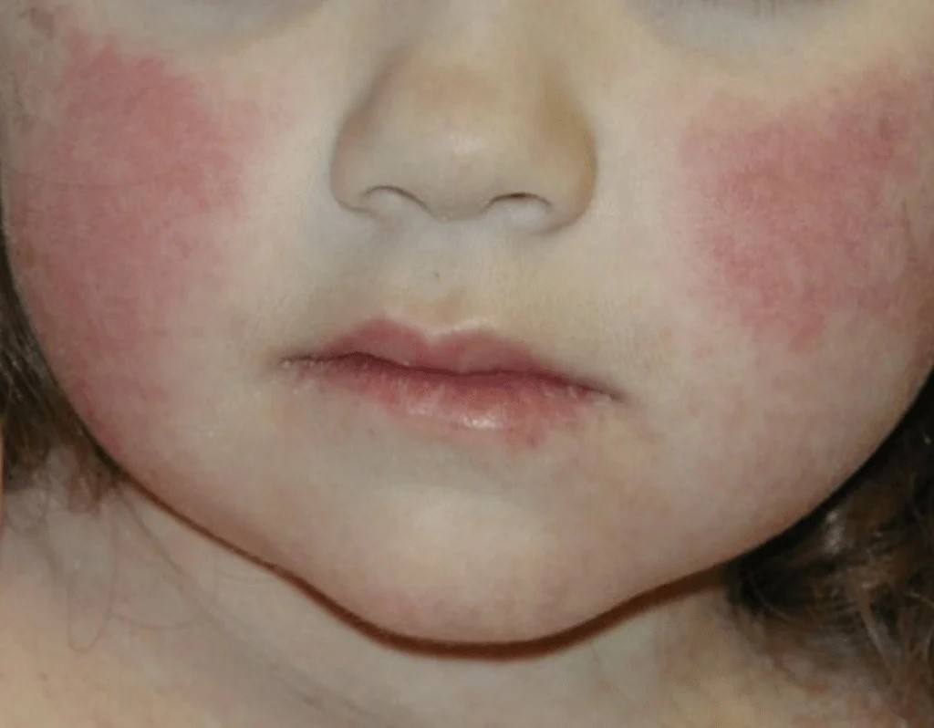 日本爆發大規模的傳染性紅斑症，俗稱「蘋果病」，患者數創下25年來新高。（翻攝X）