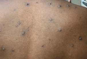 衛生福利部疾病管制署今證實,國內正式驗出首例感染「第I分支Ib子分支」(簡稱Ib型)的新型變種M痘病例。示意圖(翻攝自美國CDC)