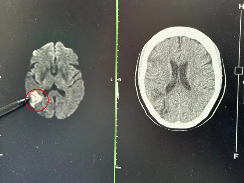 李綜合神經內科醫師張峻誠說，婦人為非典中風患者，右側大腦動脈阻塞進而影響視野。（李綜合醫院提供）