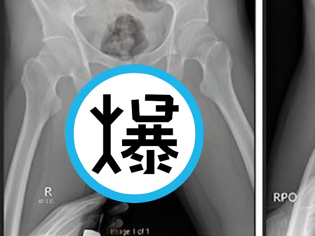 驚世GG！他把牙刷塞進生殖器，女上男下運動「啪」斷掉還變畸形。（翻自《每日郵報》）