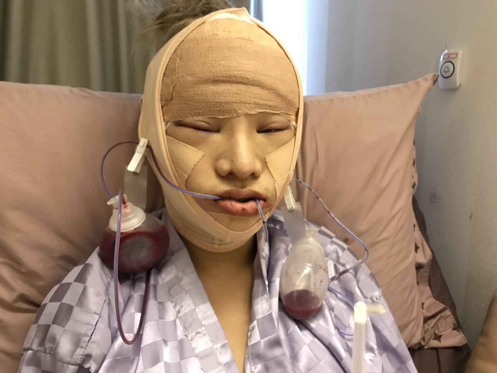 球星激戰小A辣4/術後復原艱辛過程曝 小A辣:都忍了30年這一點痛算什麼!