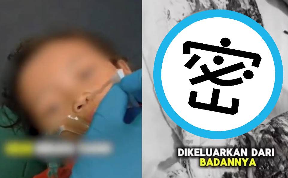 印尼一名女童體內嚴重感染蛔蟲，甚至從鼻子爬出活蟲。（翻攝X@arrahmah、@Beritasatu）