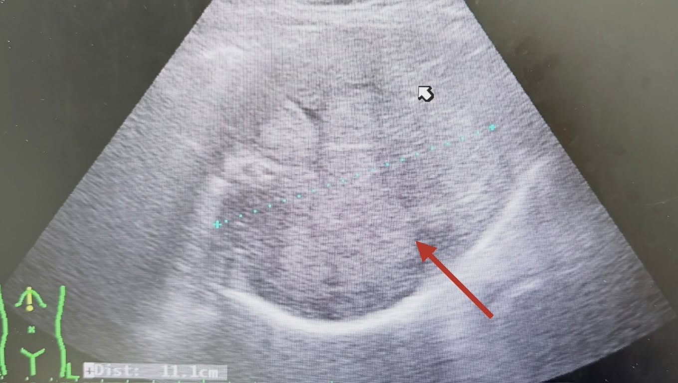 醫師分享，一名病患切除肝腫瘤後未定期追蹤，7年後因腹部疼痛就醫才發現肝臟長滿腫瘤。（翻攝臉書「張靖醫師 減重專科。靖心靖力 守護胃腸」）