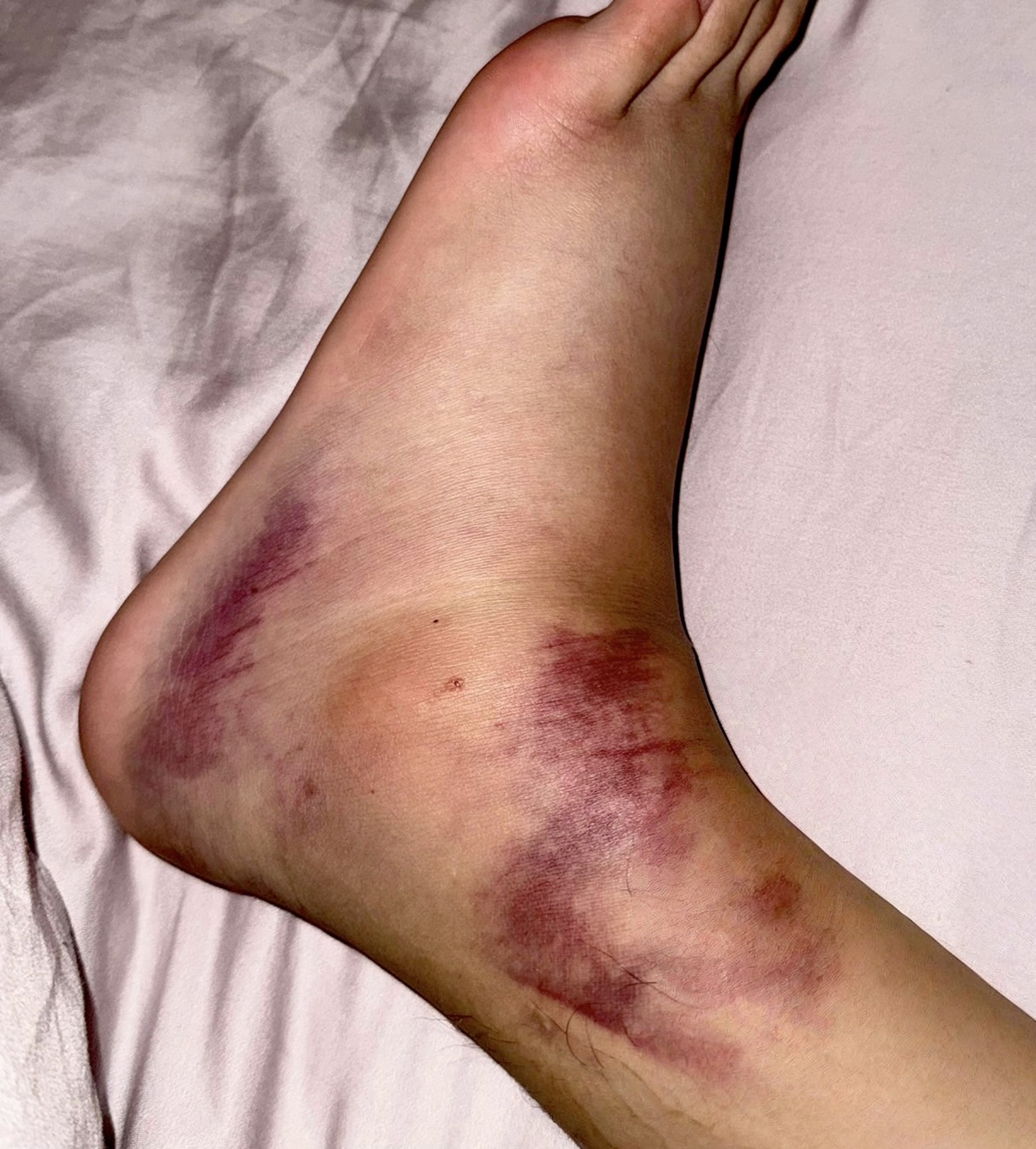 洪暐哲腳受傷後，短短幾小時腳就整個腫脹瘀血。（年代整合行銷提供）