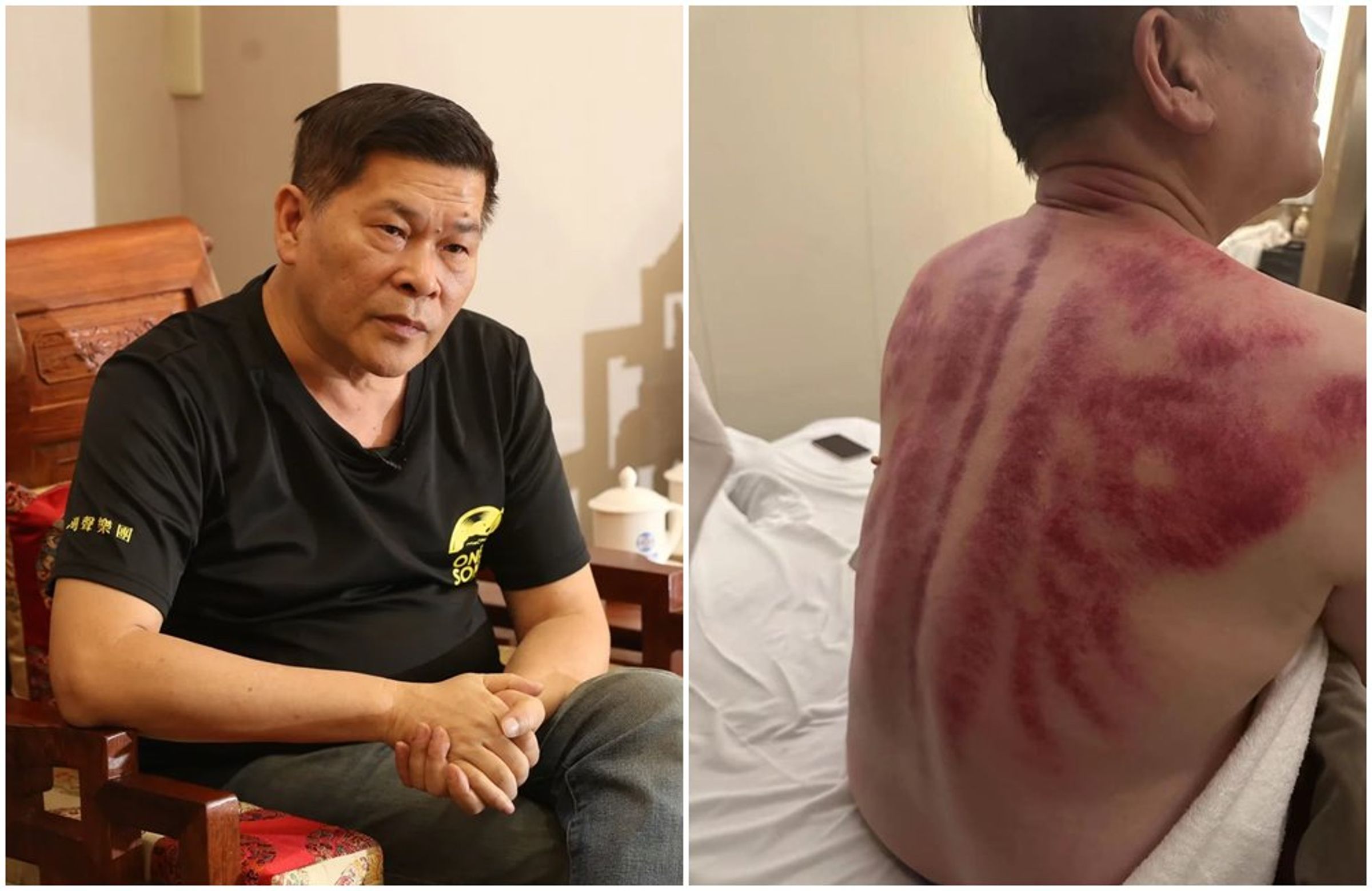 澎恰恰(左圖,本刊資料照)頂高溫拍戲,疑似中暑去刮痧。(右圖,翻攝自澎恰恰臉書)
