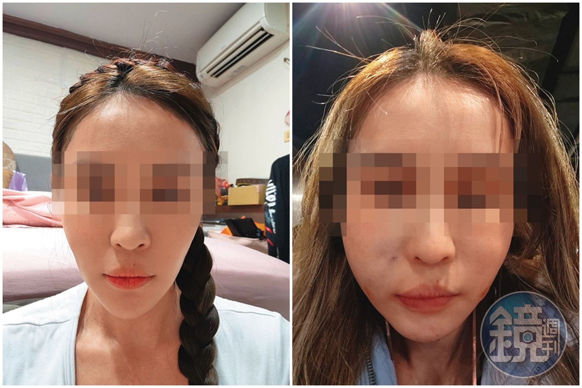診所老客戶C小姐去年底進廠維修,沒想到手術失敗,術後整張臉腫到像豬頭,讓C小姐痛不欲生。(讀者提供)