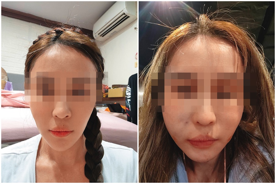 診所老客戶C小姐去年底進廠維修，沒想到手術失敗，術後整張臉腫到像豬頭，讓C小姐痛不欲生。（讀者提供）