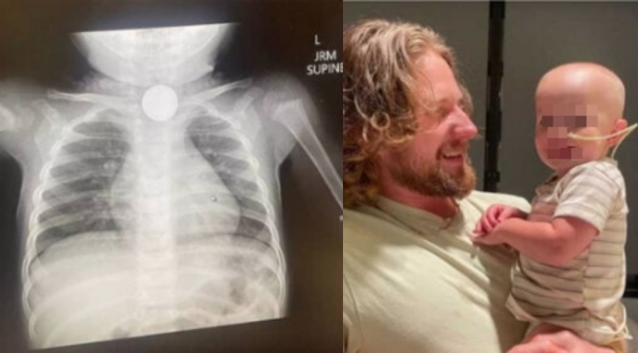 從左圖X光可見，鈕扣電池卡在食道中，位置十分危險。（Kasey Allen提供）