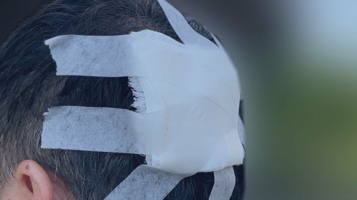 一名住在熊本的50多歲男子，在洗車時遭到「天降泥團」砸破後腦勺。（翻攝自X）