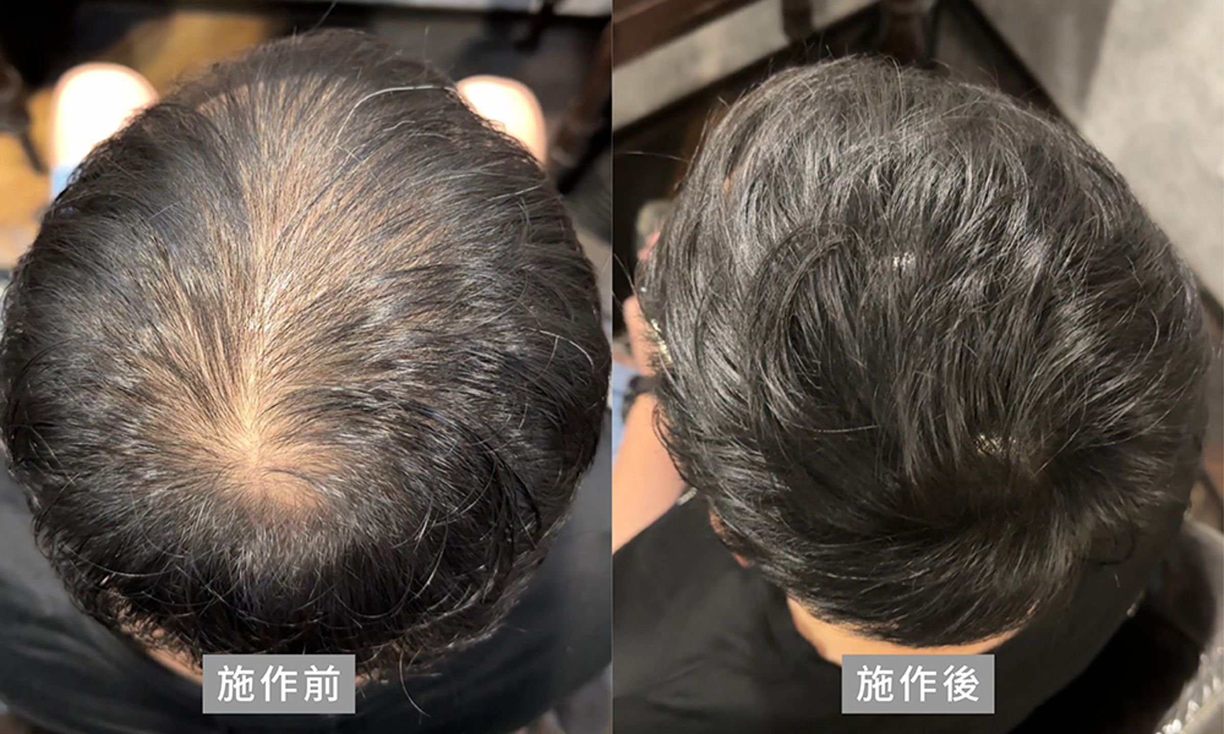 男性無修圖施作前後的差異對比,明顯感受視覺上髮量的變化(Aaron提供)。