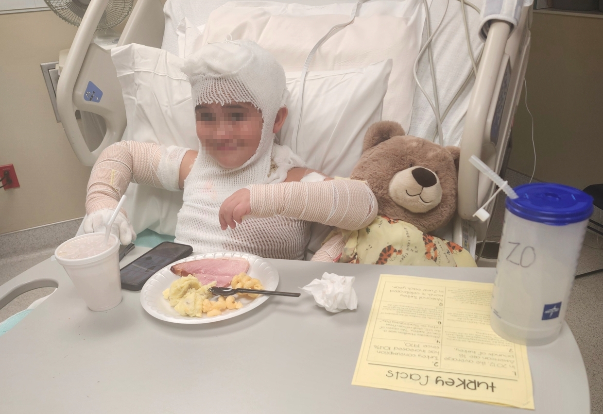 項鍊卡進充電線與插頭間隙引發火花，8歲男童脖子遭嚴重燒傷，仍在醫院接受治療。（翻攝自gofundme）