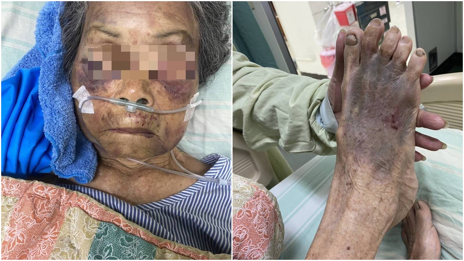 90歲阿嬤遭37歲孫子施暴，造成腦出血及臉部、四肢瘀青挫傷住進加護病房。（翻攝自臉書）