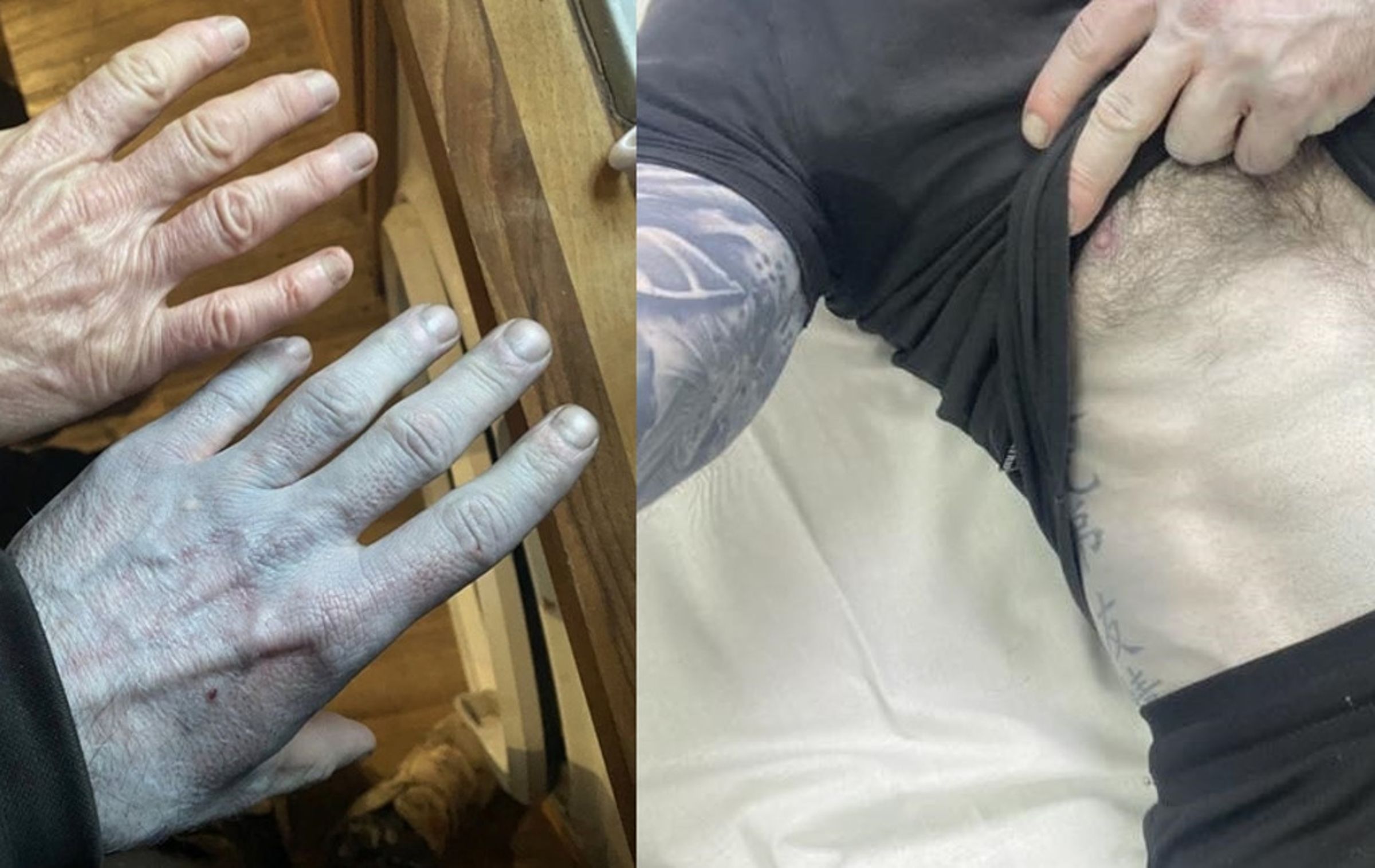 英國一名建築工人睡醒發現全身皮膚變藍色，急衝醫院急診就醫。（翻攝Tommy Lynch）

