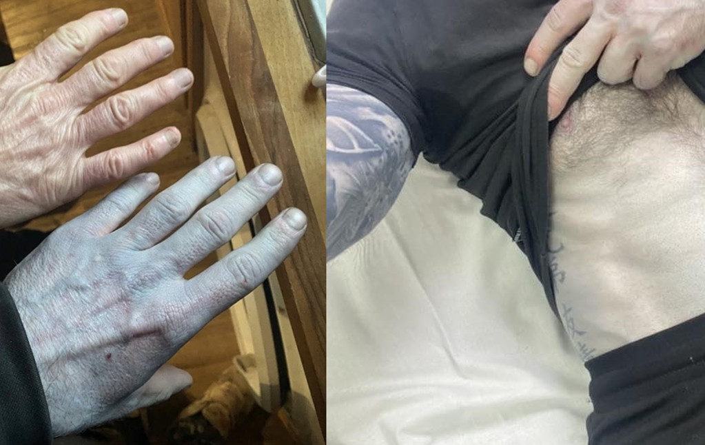 英國一名建築工人睡醒發現全身皮膚變藍色,急衝醫院急診就醫。(翻攝Tommy Lynch)