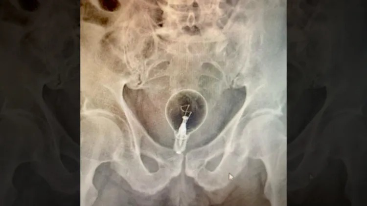 義大利一名老翁離奇塞了一顆燈泡在體內。（翻攝自《binews.it》）