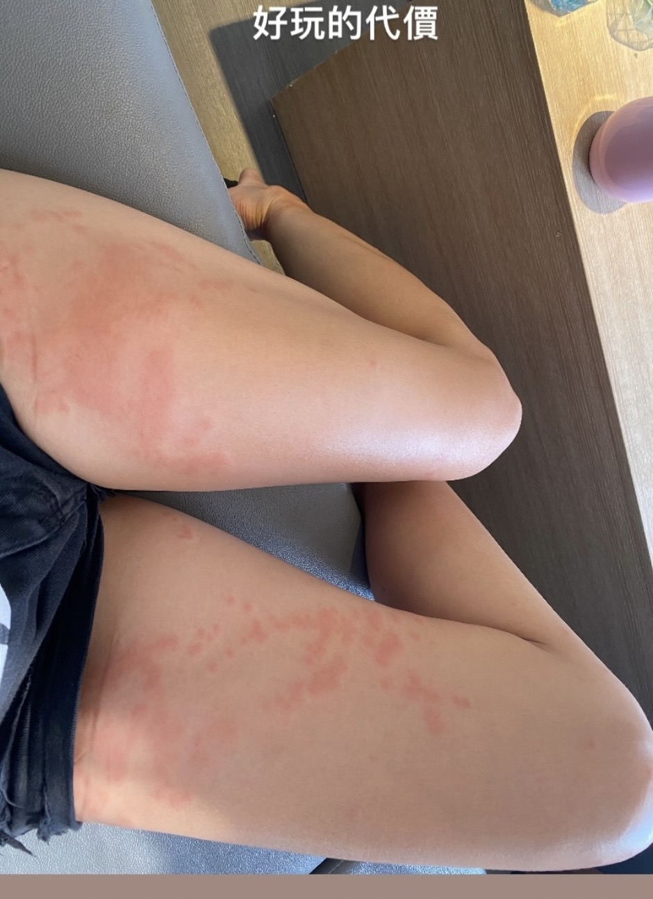 鍾瑶腿部大面積被水母螫奇癢無比。（翻攝自IG）