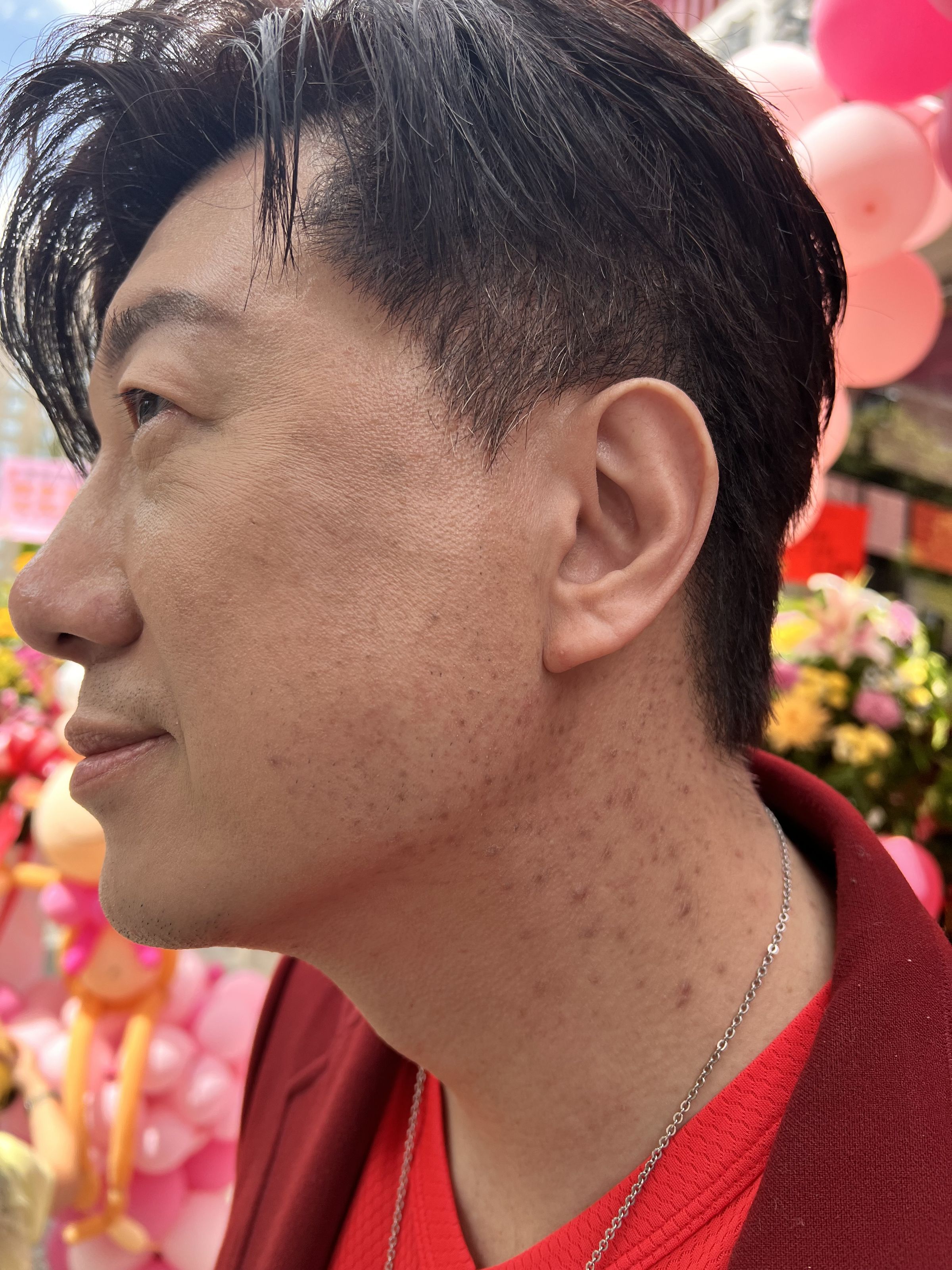 吳皓昇因脖子長期沾到女兒生髮的藥導致大片毛囊炎。（民視提供）