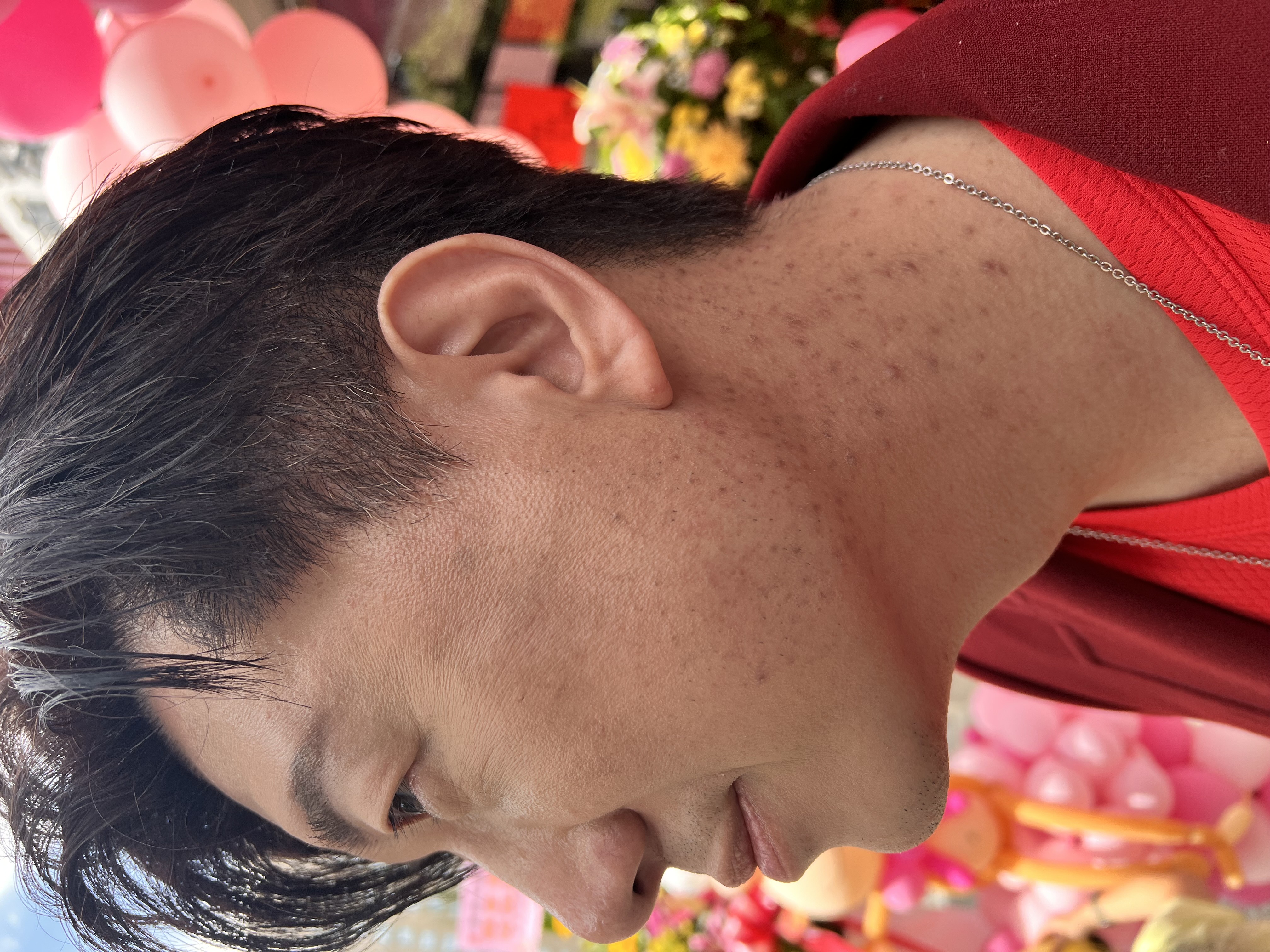 吳皓昇因脖子長期沾到女兒生髮的藥導致大片毛囊炎。（民視提供）