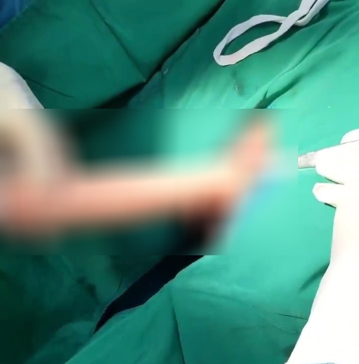 醫師手術取出這根異物。(翻自《青年報》)