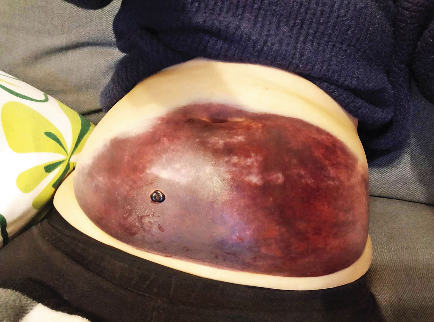 B小姐做試管導致腹部大片紫青腫脹，胚胎卻因吳素慧行蹤不明數月。（讀者提供）