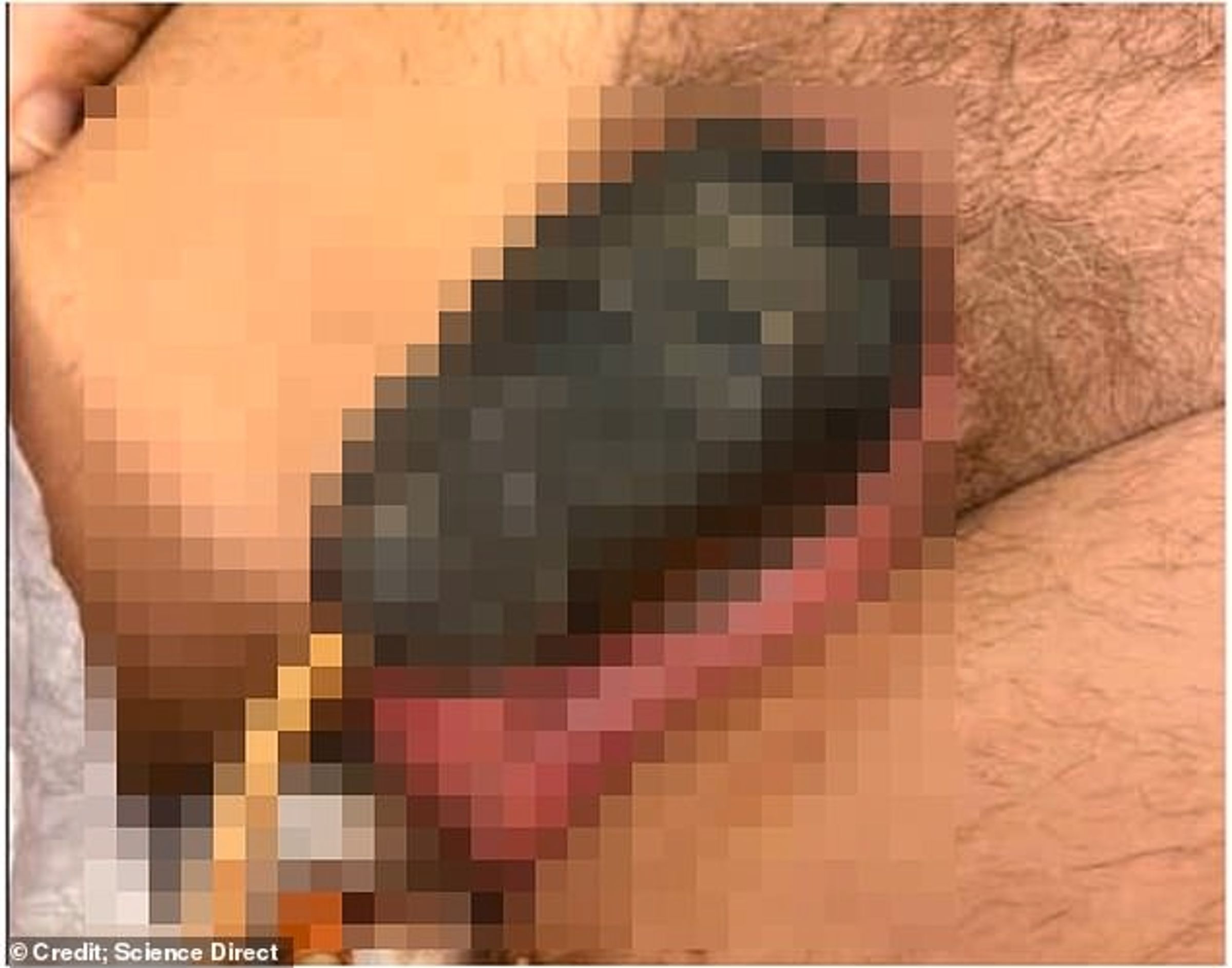 男子的生殖器頭部已經完全壞死。（翻自《每日郵報》）