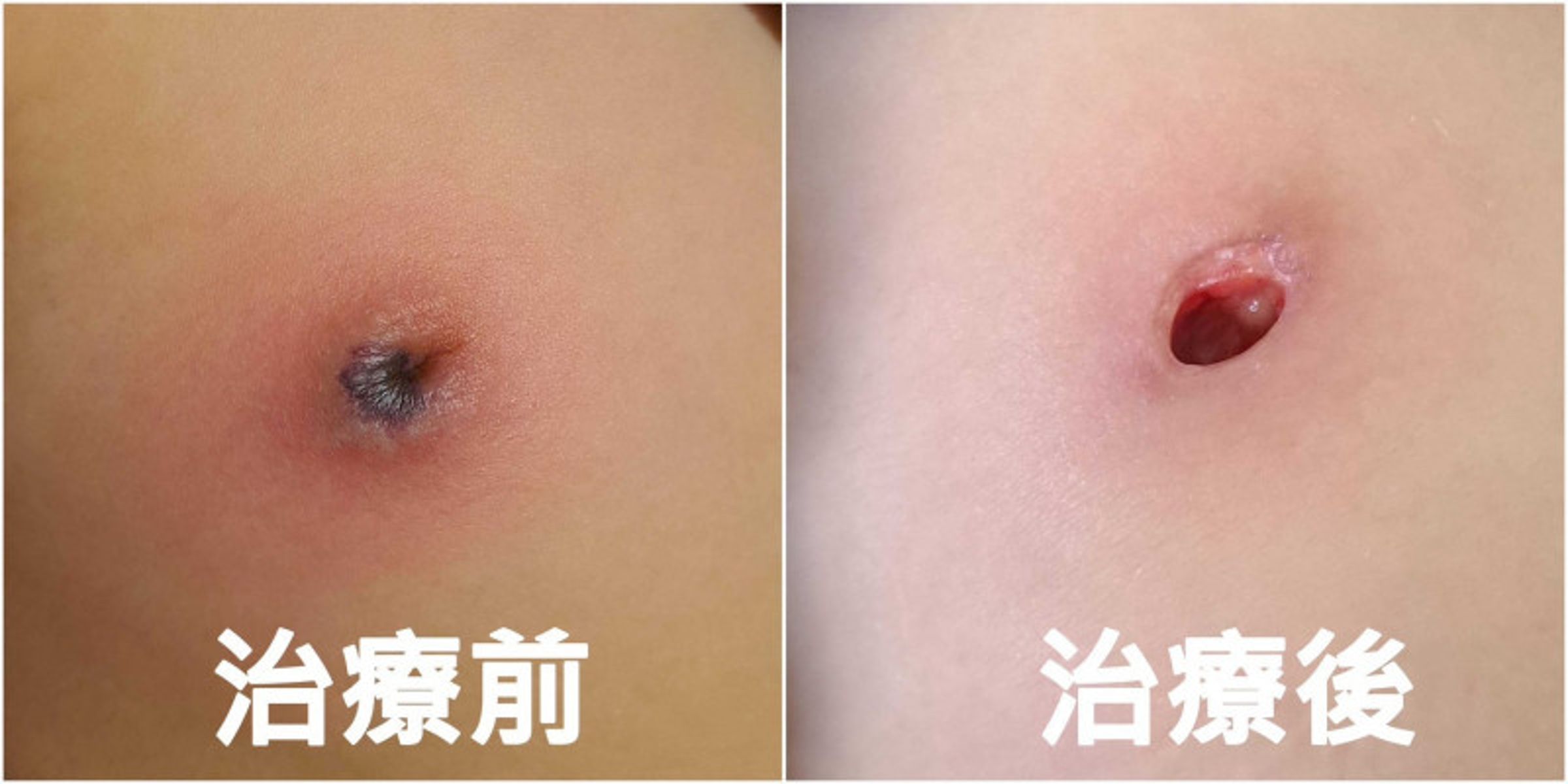 女童右側乳頭周圍出現大片紅腫,且乳頭周邊組織「幾乎被吃光」出現凹洞。(亞大醫院提供)