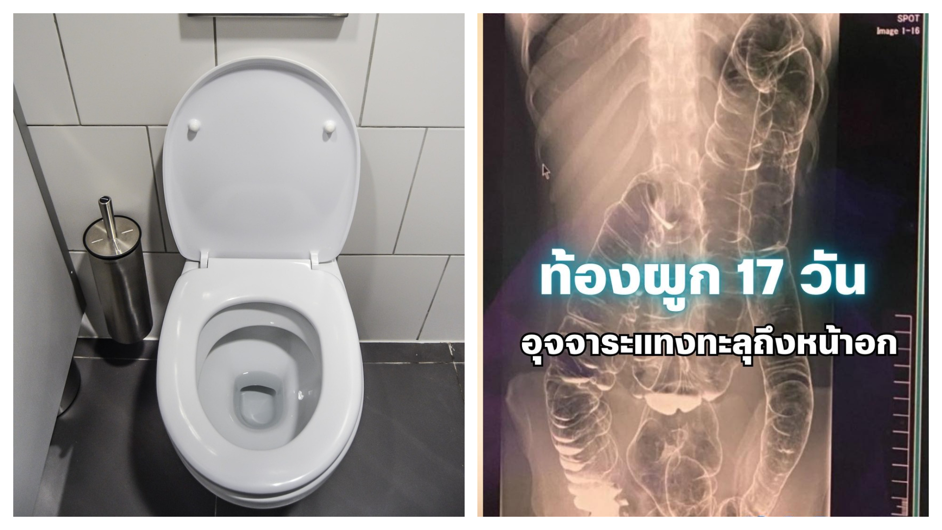 1名台灣年輕女子便祕17天導致結腸破裂，甚至擠壓到胸腔，幾乎喪命，所幸及時動手術才保住性命。（Pixabay／Image by Michal Jarmoluk、翻攝自臉書@หมอที่ดีที่สุดคือตัวคุณเอง by Saranruss ）