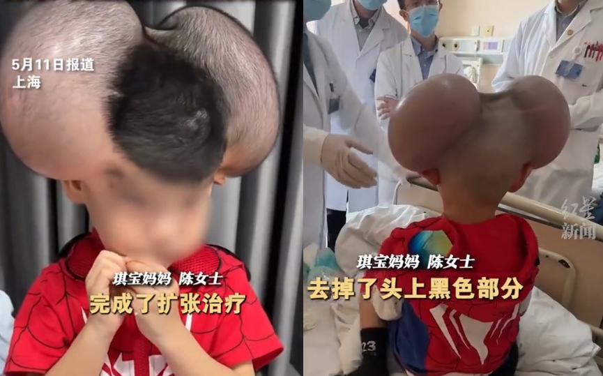 琪寶頭部被植入擴張器，定期注水擴張頭皮。（翻攝微博）