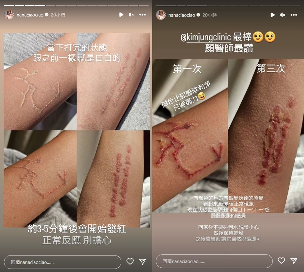 阿圓分享除刺青的術後照，有部分地方燒焦。（翻攝自一隻阿圓IG）